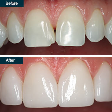Before After Cosmetic Dental Bonding
