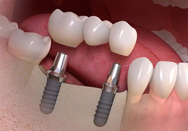 Multiple Teeth Implants