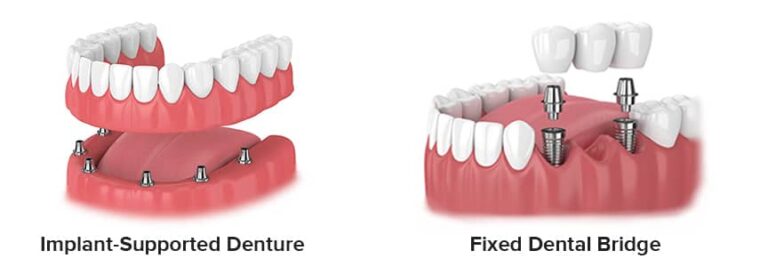 how-many-dental-implants-do-i-need-for-a-denture-or-fixed-bridge