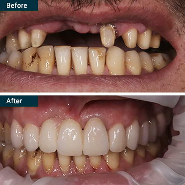 Before After All on 4 Yonkers Westchester NY