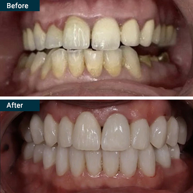 Before After All on 4 Yonkers Westchester NY