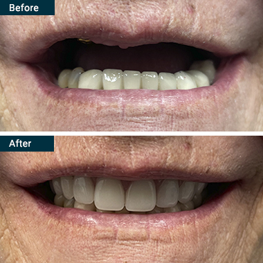 Before After All on 4 Yonkers Westchester NY