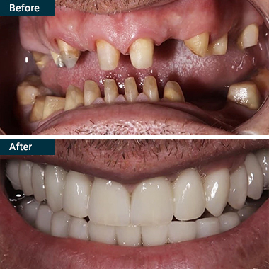 Before After All on 5 Yonkers Westchester NY