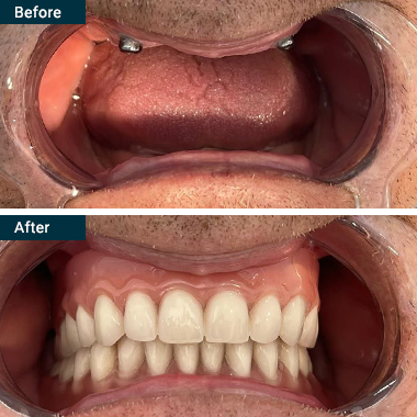 Before After All on 6 Yonkers Westchester NY