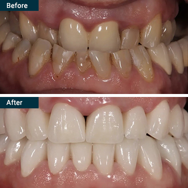 Before After All on 4 Yonkers Westchester NY