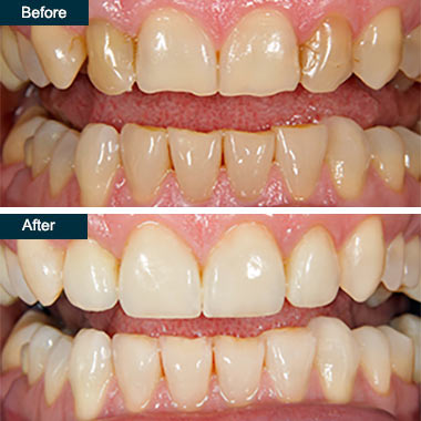 Before and After Cosmetic Dental Bonding 3 Yonkers NY