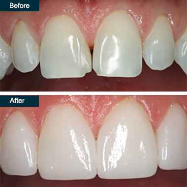 Before and After Cosmetic Dental Bonding Yonkers NY