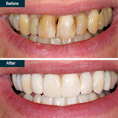 Before and After Dental Deep Teeth Cleaning Yonkers NY