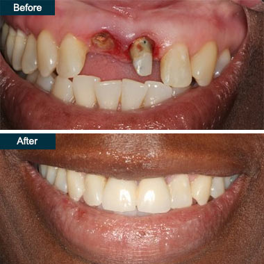 Before and After Dental Implants Dentist Yonkers NY