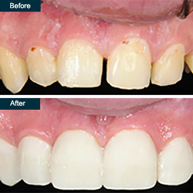 Before After Dental Smile Makeover Yonkers NY