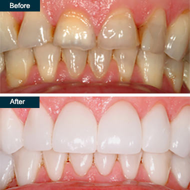 Before and After Porcelain Dental Crowns Yonkers NY