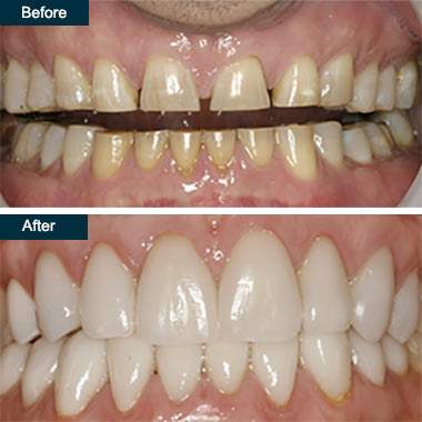 Before and After Press On Dental Veneers Yonkers NY