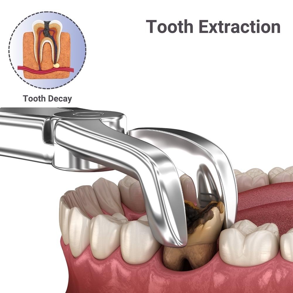 Tooth Extraction